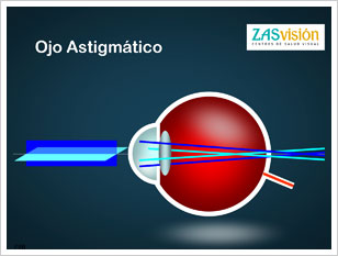Esquema de un ojo con astigmatismo